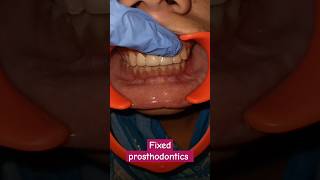 Fixed prosthodontics dentalcafe4331 [upl. by Tadio778]