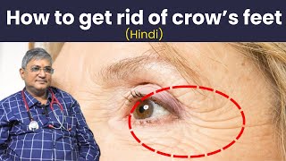 how to get rid of crows feet  crows feet  how to get rid of crows feet and bags under your eyes [upl. by Rimas]