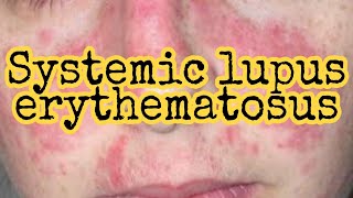 SLE Systemic lupus erythematosus in hindi  SLE part 1  Eduluminescence [upl. by Rochelle]