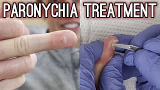 SATISFYING Drainage of Infected Cuticle  Paronychia Treatment  TheBubbaArmy [upl. by Akelam109]