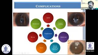 Vernal Keratoconjunctivitis  Prof Rajesh Sinha [upl. by Hoffert671]