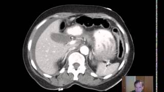 CT Mesenteric volvulus DISCUSSION [upl. by Ellekram]