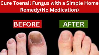 Cure Toenail Fungus with a Simple Home RemedyNo Medication [upl. by Jamille]