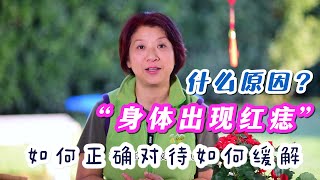 （459【痣是身體的信號】痣有黑痣和血痣，對身體也沒有影響，如何注意！血痣和黑痣的区别是什么？为什么会导致红痣出现？Joanna澳洲生活 [upl. by Midian]