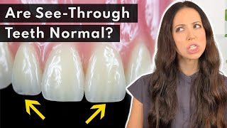 Why Are My Teeth TRANSLUCENT amp How to FIX It 🦷 [upl. by Aleahpar]