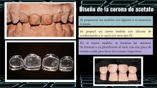 Reporte de caso coronas de acetato en odontología pediátrica [upl. by Ellennahc]