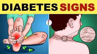 Diabetes Symptoms  Diabetes Mellitus  Type 2 Diabetes  Signs amp Symptoms  Diabetes Warning Signs [upl. by Starkey]