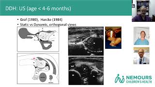 Developmental Dysplasia of the Hip [upl. by Zeus961]