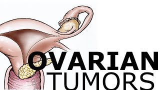 Ovarian Pathology amp Tumors [upl. by Shreve]