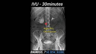 PUJ Obstruction  IVU  Diagnosis  Practical Case Radiology [upl. by Noah]