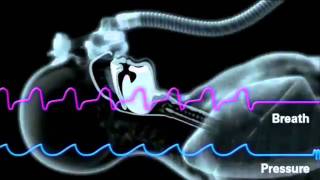 ResMed S9 Series Enhanced Autoset Algorithm Technology [upl. by Cloe]