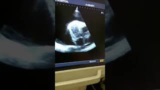 Massive Pericardial Effusion with Impending Tamponade Echo by Dr Sagun Dawadi [upl. by Farver]