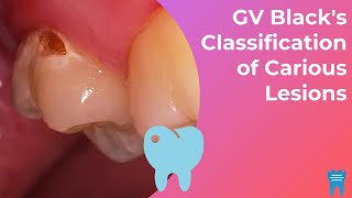 How to classify dental caries  GV Blacks Classification of Caries [upl. by Yznil516]