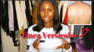 ITS NOT ECZEMA Treating my Tinea Versicolor  Black Skin Friendly [upl. by Brandes]