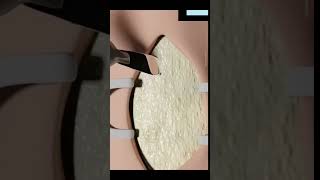 Tracheostomy procedure explained facts 3danimationfact funfacts [upl. by Isbella229]