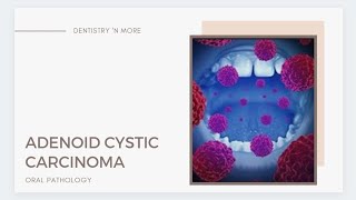 ADENOID CYSTIC CARCINOMA [upl. by Anitselec]