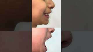 Kids jaw correction children posture correction early orthodontic treatment in the childhood ￼ [upl. by Kellen]