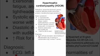 Hypertrophic cardiomyopathy HOCM [upl. by Seana418]