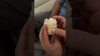 Kronen Veeners amp Implantate in der Türkei Antalya 🦷✅Unkompliziert anfragen 📩veneers zähne [upl. by Aima239]