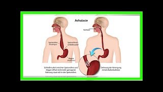 Behandlung für Achalasie [upl. by Nathanson]