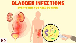 Bladder Infections The Silent Epidemic Affecting Millions of Women [upl. by Anitsirc821]