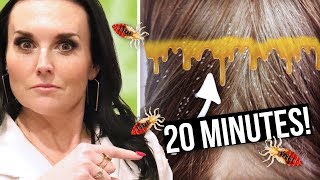 How to GET RID of LICE in 20 Minutes  Lice Clinics of America Active Rinse [upl. by Idnahc]