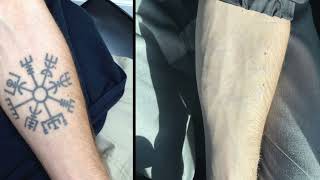 Before and After Laser Tattoo Removal [upl. by Carmina628]