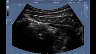 Abdominal RUSI ultrasound  correct contraction of the transversus abdominis [upl. by Kenna]