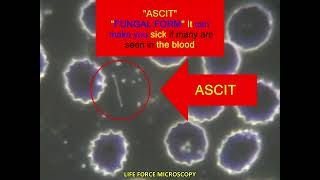 LIVE BLOOD ANALYSIS VERY TOXIC FUNGAL FORMS [upl. by Nevag624]