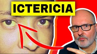 ICTERICIA 💥causas síntomas signos y analítica [upl. by Ishmael]