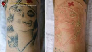 👹 Saline Tattoo Removal – Everything you need to learn about tattoo removing Page teaser [upl. by Ididn]