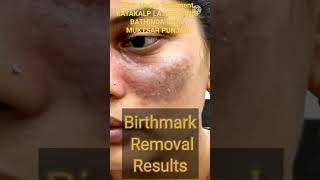 Birthmark Treatment Results I Birthmark I birthmarkremoval [upl. by Eirehc]