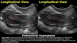 Uterus Ultrasound Reporting  Uterine Disease Scan Reports  How To Write USG Report  Pelvic USG [upl. by Harrington]