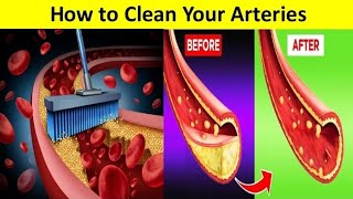 Unclog arteries Cleaning diet Heart attack preventionNatural ways to clean arteries UrduHindi [upl. by Cy]