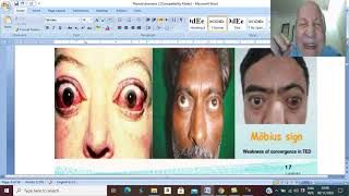 Thyroid disorders in Arabic 10  Thyrotoxicosis  part 3   by Dr Wahdan [upl. by Mindy]