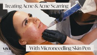 This Is Microneedling for Acne Scarring 🎯 [upl. by Neelear]