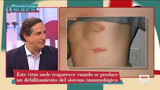 Tipos de herpes y cómo tratarlos con el Doctor Mariscal  Estando Contigo [upl. by Ociral78]