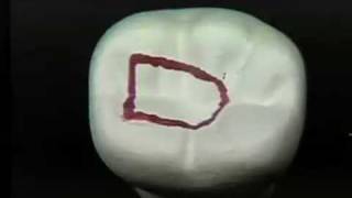 Endodontic Cavity Preparation  Phase I  Posterior [upl. by Shelly264]