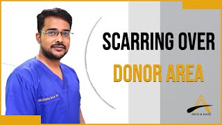 Scarring Over Donor area alloroots [upl. by Sueahccaz]