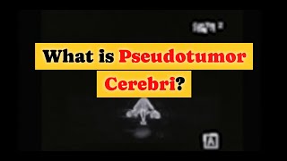 What is Pseudotumor Cerebri [upl. by Amol]