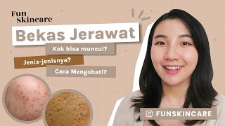 Skincare untuk Bekas Jerawat  PIH PIE Bopeng skintalk [upl. by Oreste]