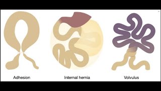 Closed loop obstruction with bowel ischemia  CT findings [upl. by Wendye192]