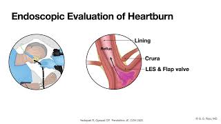 GERD  Endoscopic Evaluation  Principles [upl. by Hopfinger]