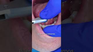 🦷 Recupera tus dientes incisivos inferiores gracias a los implantes dentales implantesdentales [upl. by Gabrielson917]