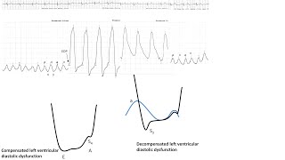 Hemodynamics 1 Essential hemodynamics pitfalls anomalies Elias Hanna Univ Iowa [upl. by Yarased]