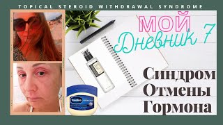 7Дневник Синдром Отмены Гормональной мази Topical Steroid Withdrawal Syndrome Вазелин CosrX [upl. by Ydualc]