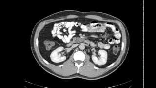 Overview da anatomia do abdome pela TC [upl. by Vanna]