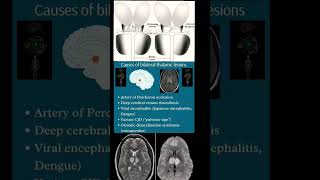 Bilateral thalamic lesions  Cause  Radiology [upl. by Laura]