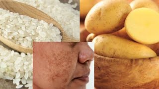 Mascarilla Natural Para Tratar La Pigmentación Facial y Las Manchas 🥔🥔 [upl. by Bashemeth47]