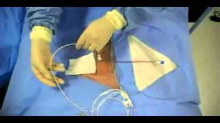 Insertion of Transvenous Pacemaker [upl. by Reynold]